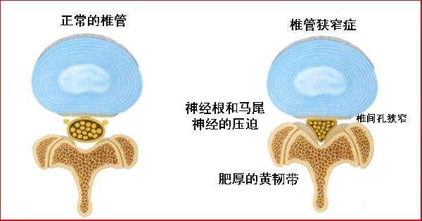 “十人九腰痛”腰椎病缠身好多年,中医对症施治是关键!