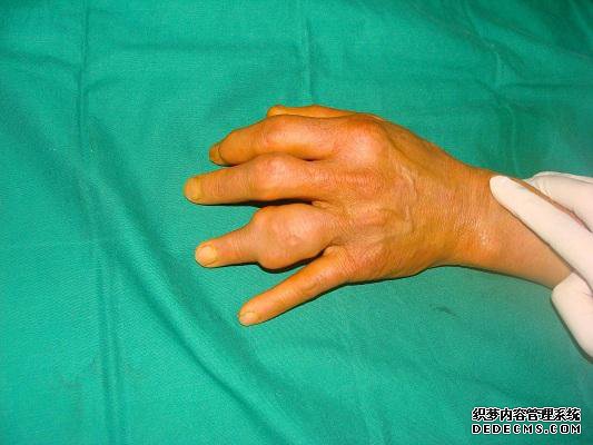 痛风如何快速止痛?特效食疗“两方”,人人家中都有